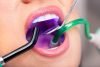 Understanding The Different Types Of Dental Fillings